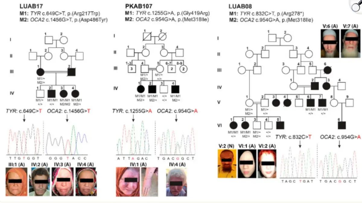 Graph from the 2021 study "Genetic Causes of Oculocutaneous Albinism in Pakistani Population." Sajid et al., Genes 2021, 12(4), 492, CC BY 4.0, via MDPI